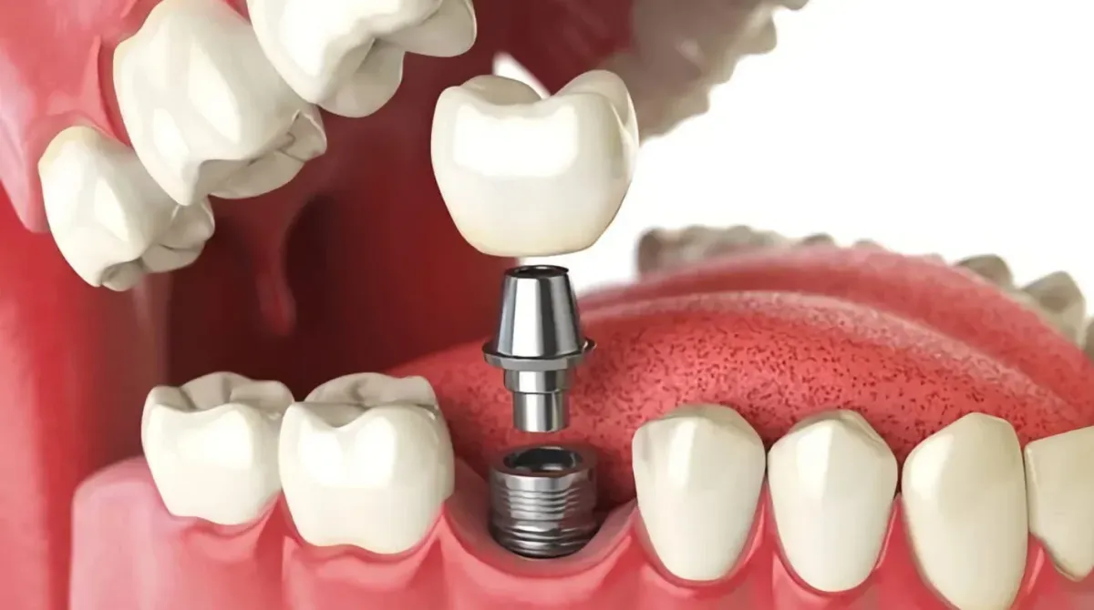 implantes